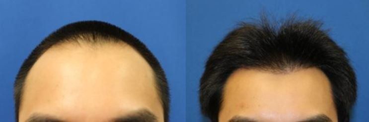 Hair restoration