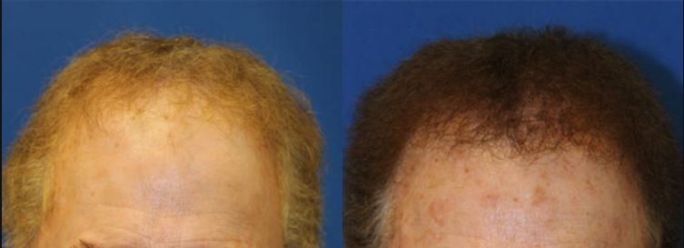 Hair restoration