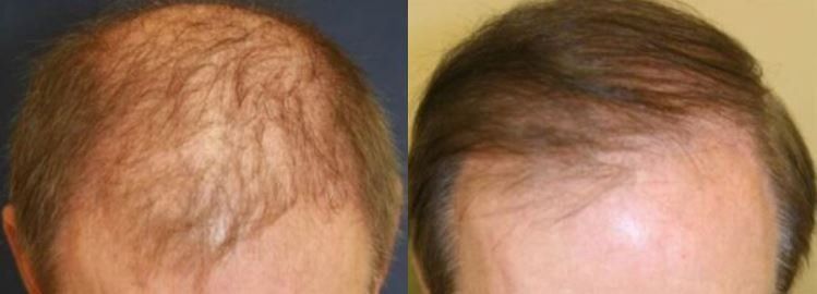 Hair restoration