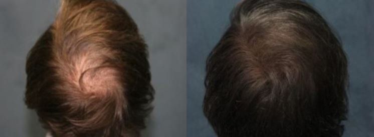 Hair restoration