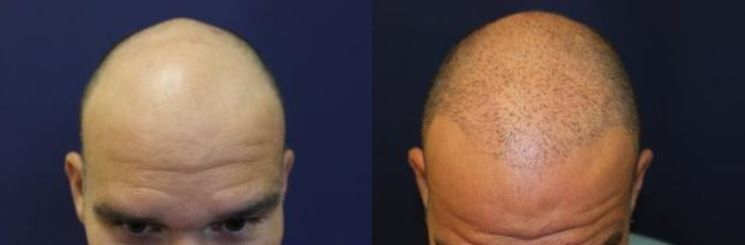 Hair restoration