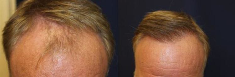 Hair restoration