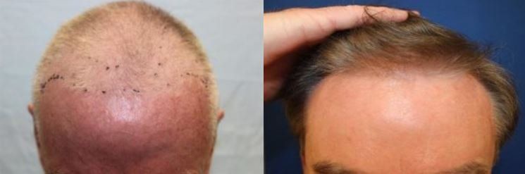 Hair restoration