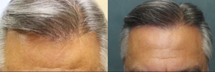 Hair restoration