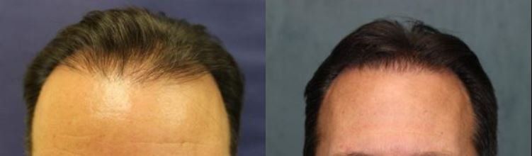 Hair restoration