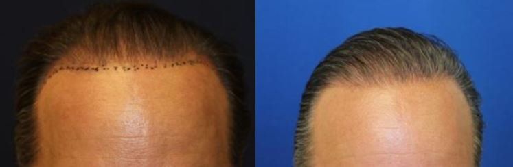 Hair restoration