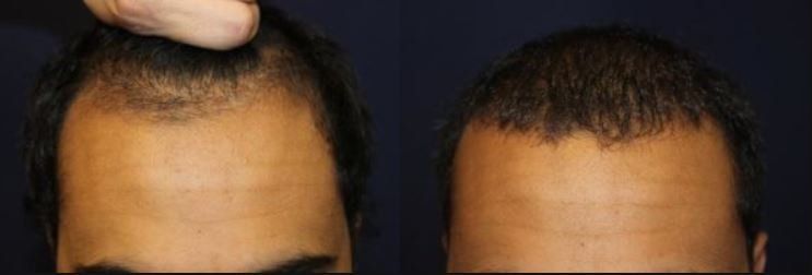 Hair restoration