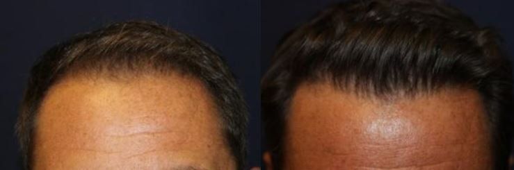 Hair restoration