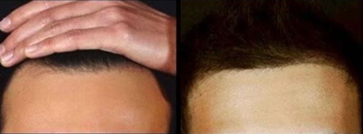 Hair restoration