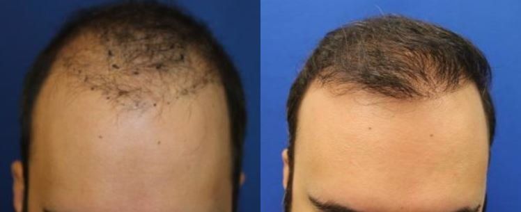 Hair restoration