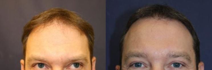 Hair restoration