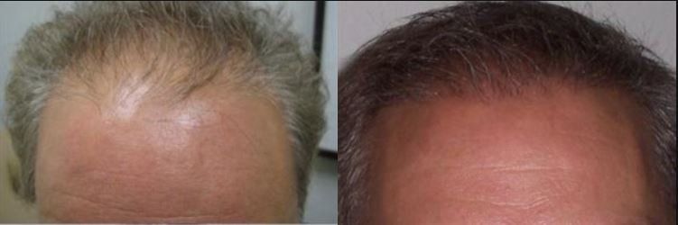A before and after picture of a man 's hair growth.