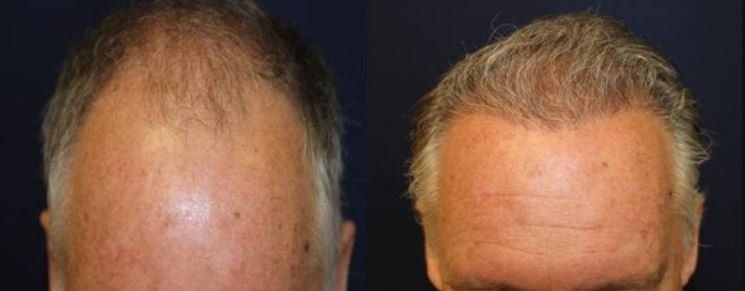 A before and after photo of a man 's head with hair loss.