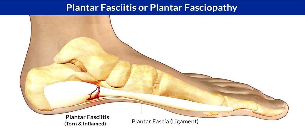 Brownstown. PA - Plantar Fasciitis Pain Relief by Chiropractor & Doctor local near me in Brownstown, PA
