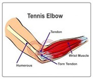 Lancaster, PA - Tennis Elbow Pain Relief treatment & Therapy by Chiropractor & Dr local near me in Lancaster, PA
