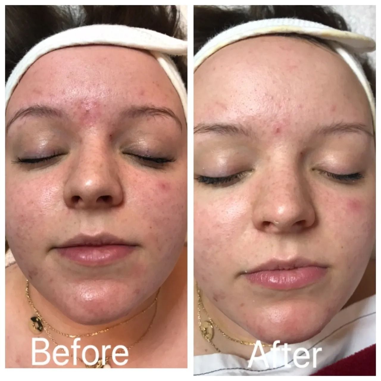 Side-by-side facial before-and-after photo showing reduced redness and blemishes after treatment