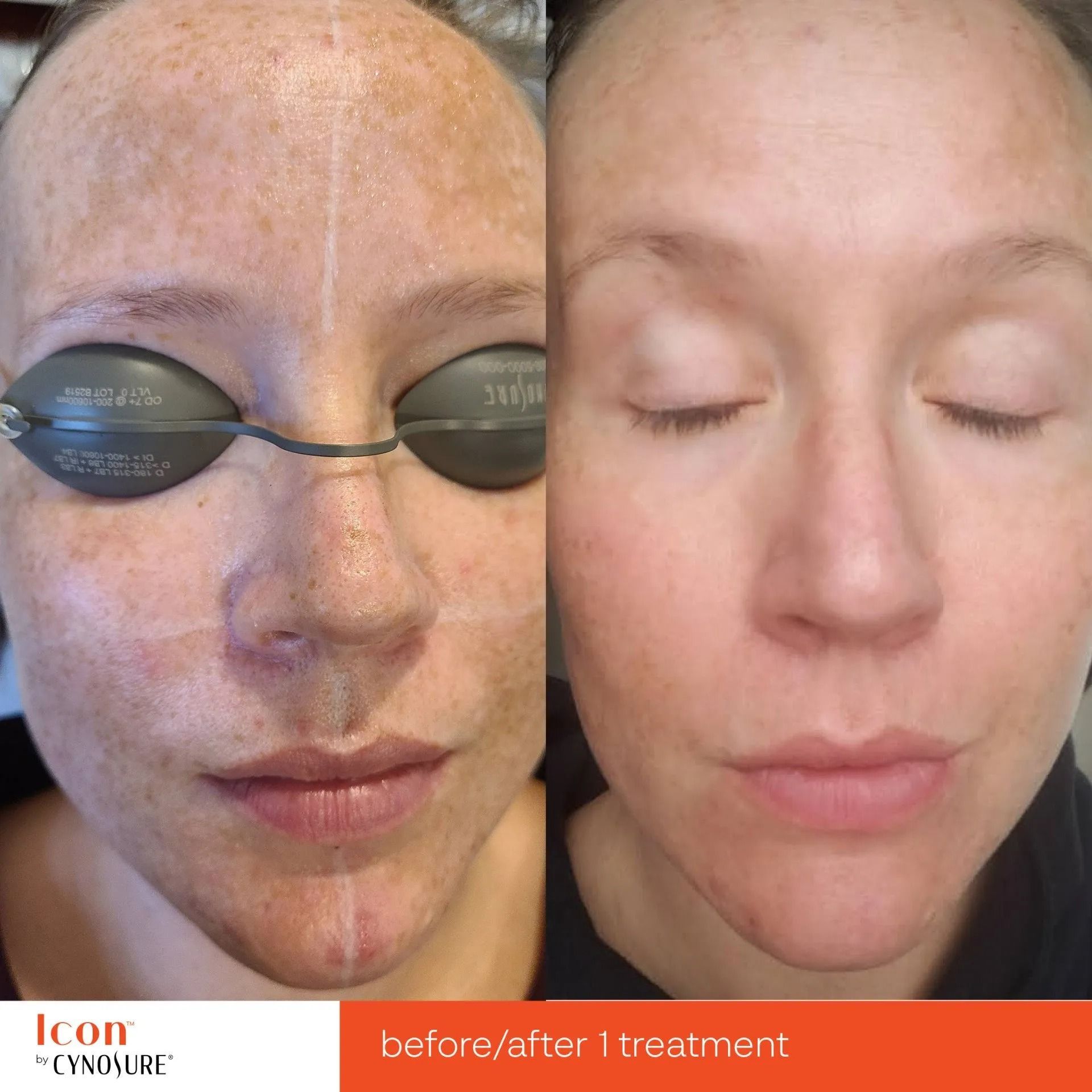 Before-and-after facial treatment photo: left face with dark spots, right face clearer and brighter.