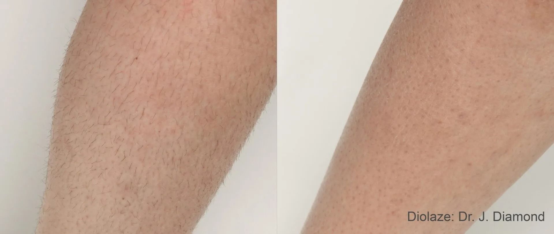 Close-up of two bent human legs with a skin rash or rough bumps on the calves