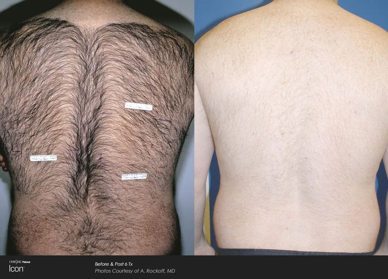 Back view comparison of a hairy back and a smooth back, with marked spots on the left image