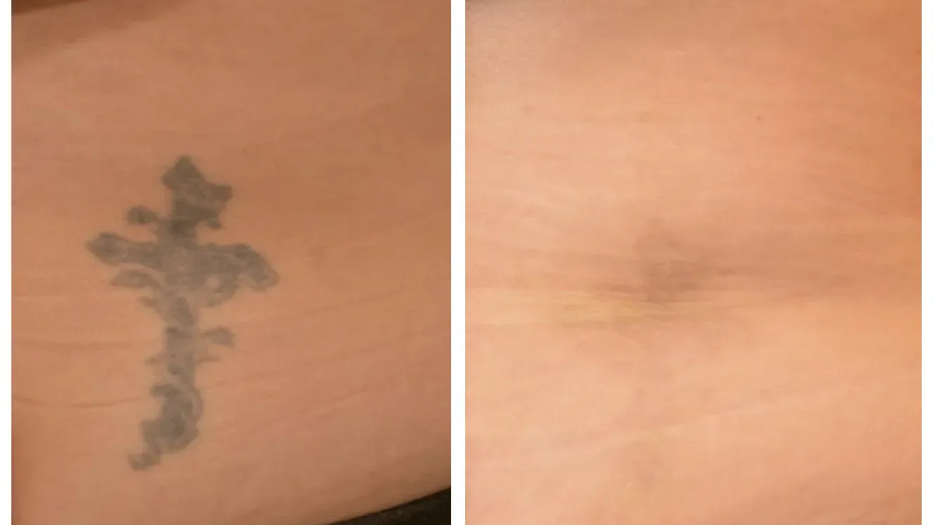 Before-and-after skin photo showing a dark cross-shaped tattoo on the left and faded skin on the right