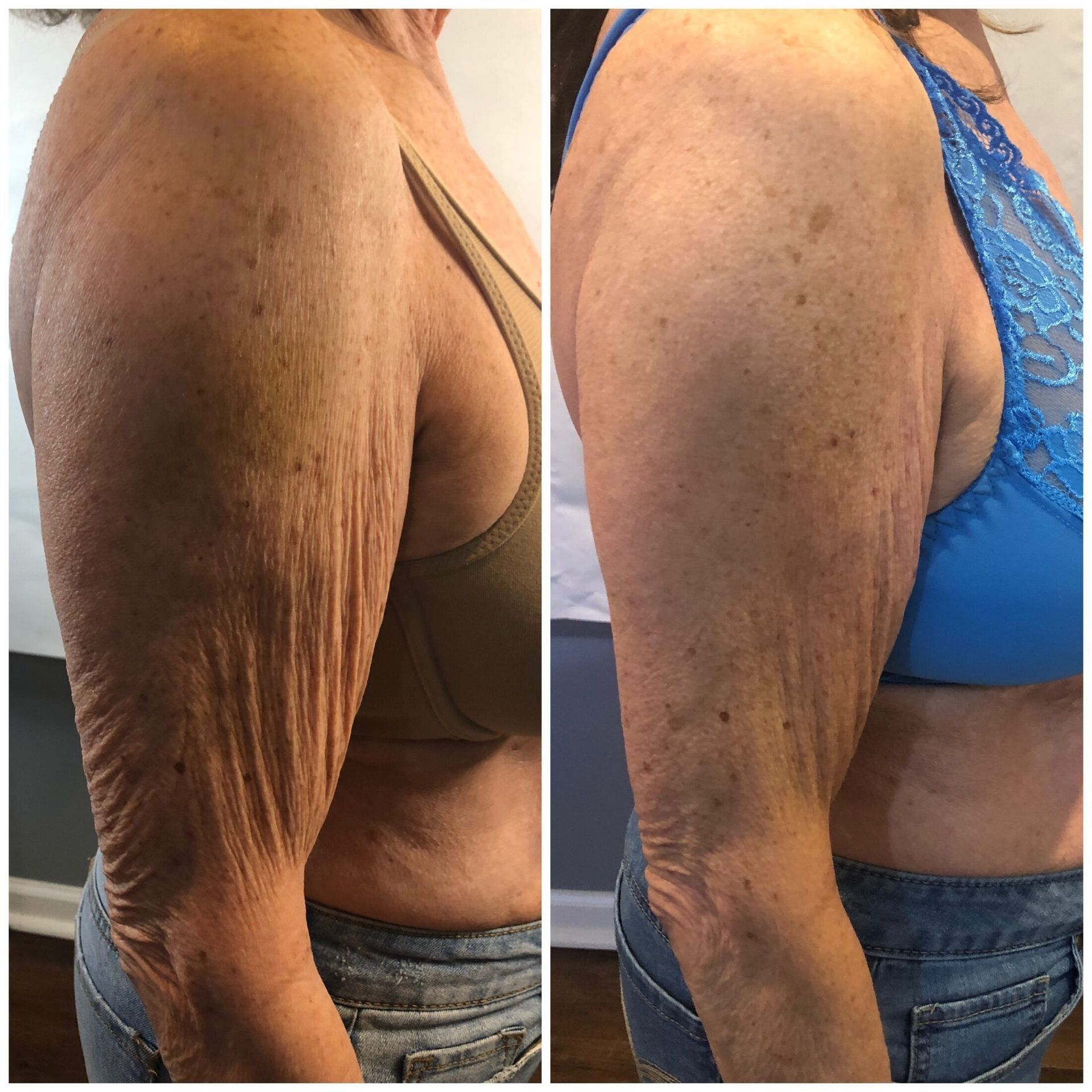 Side-by-side arm skin comparison showing loose, wrinkled skin before and smoother skin after.