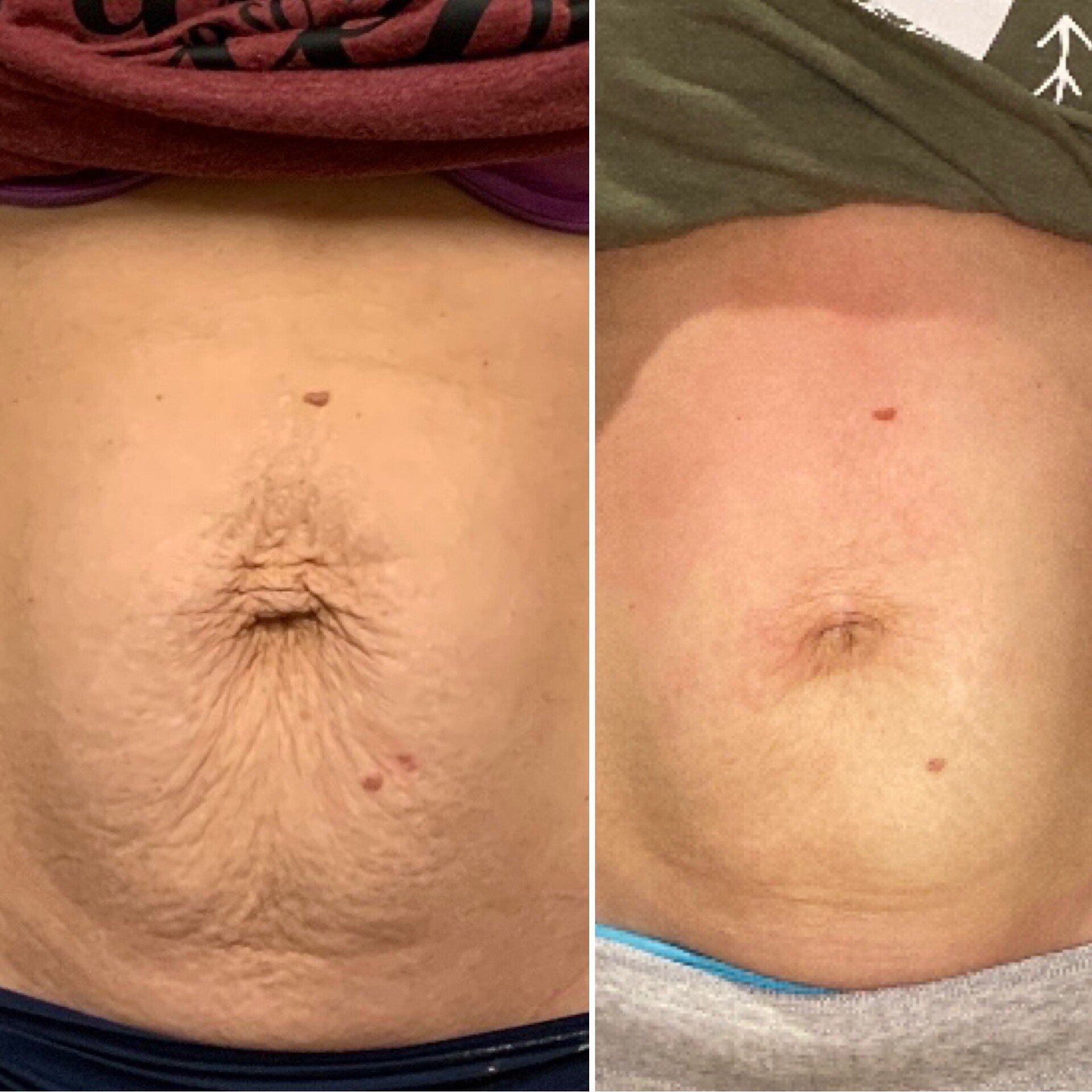 Side-by-side close-up of a bare abdomen and navel, showing a larger belly on the left and a flatter one on the right.
