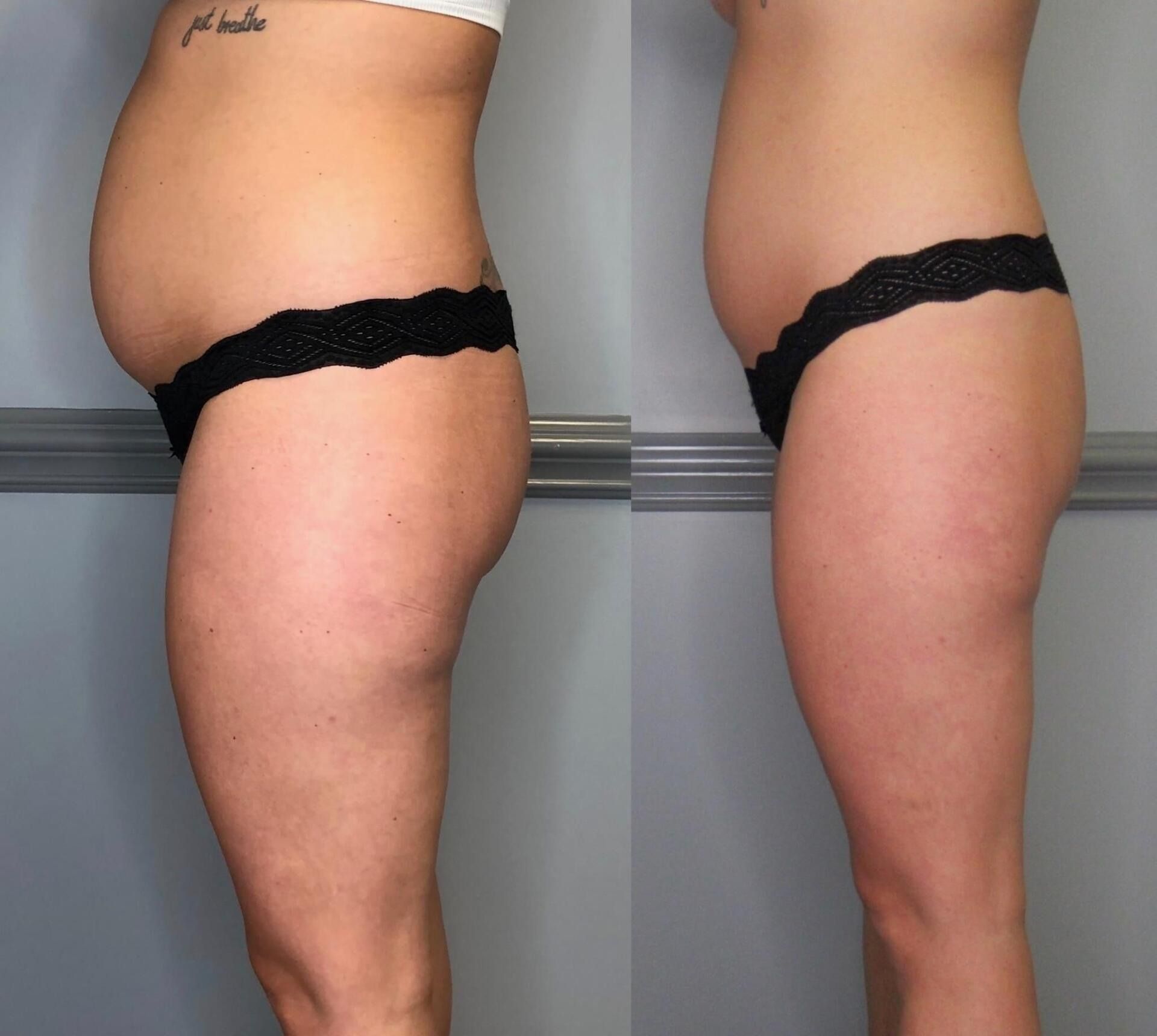 Side-by-side side-profile photos of a person's torso and legs, wearing black underwear.