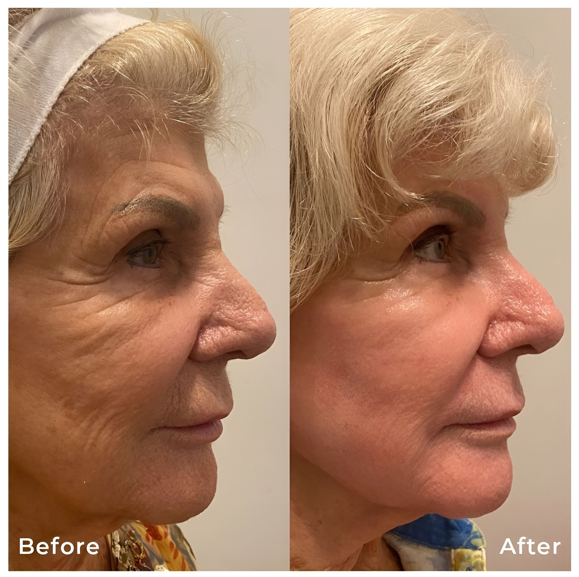 Side-by-side before and after profile of an older woman with smoother facial skin and styled blonde hair