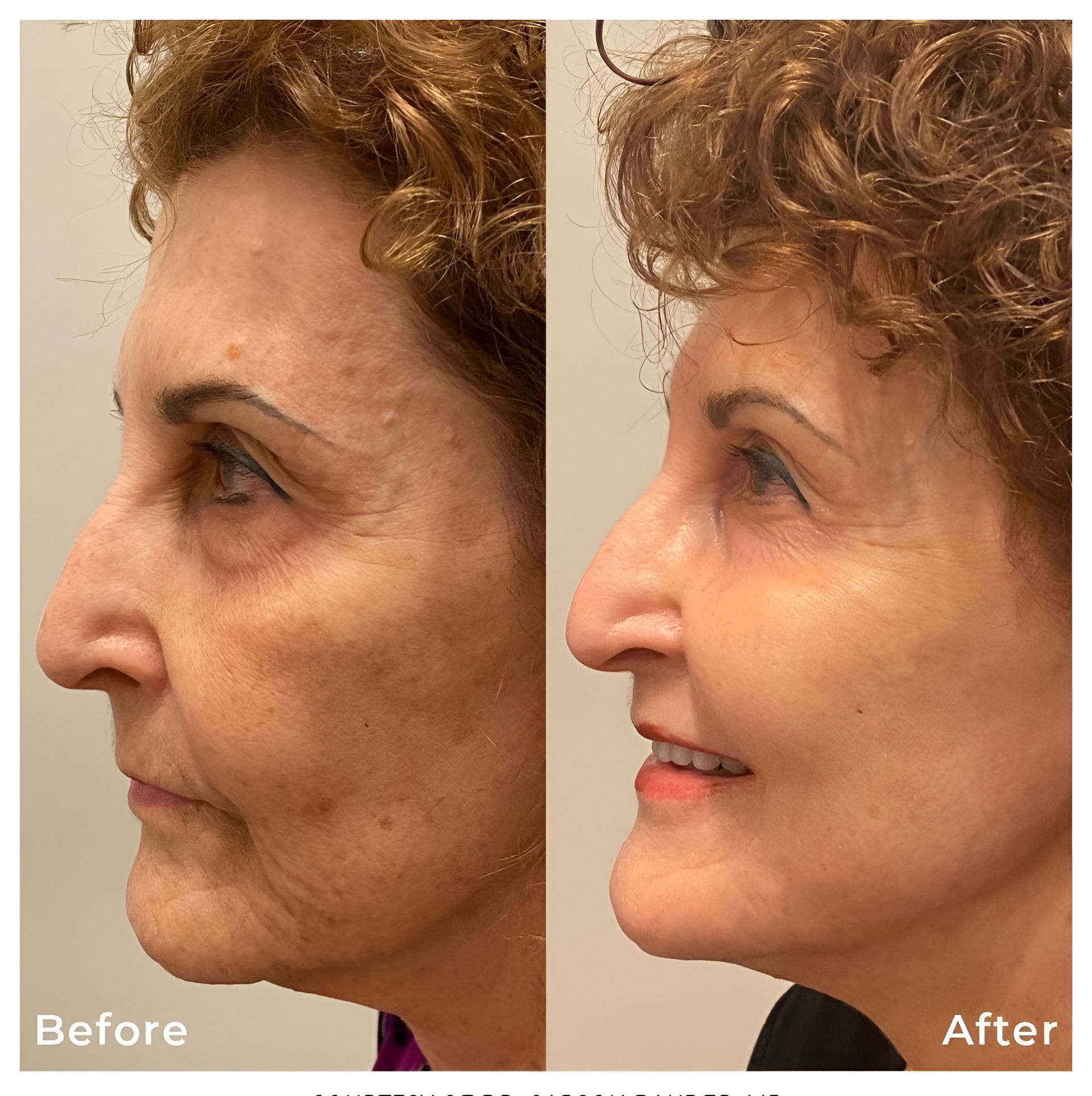 Side-by-side profile photos of a woman labeled Before and After, showing smoother skin after treatment