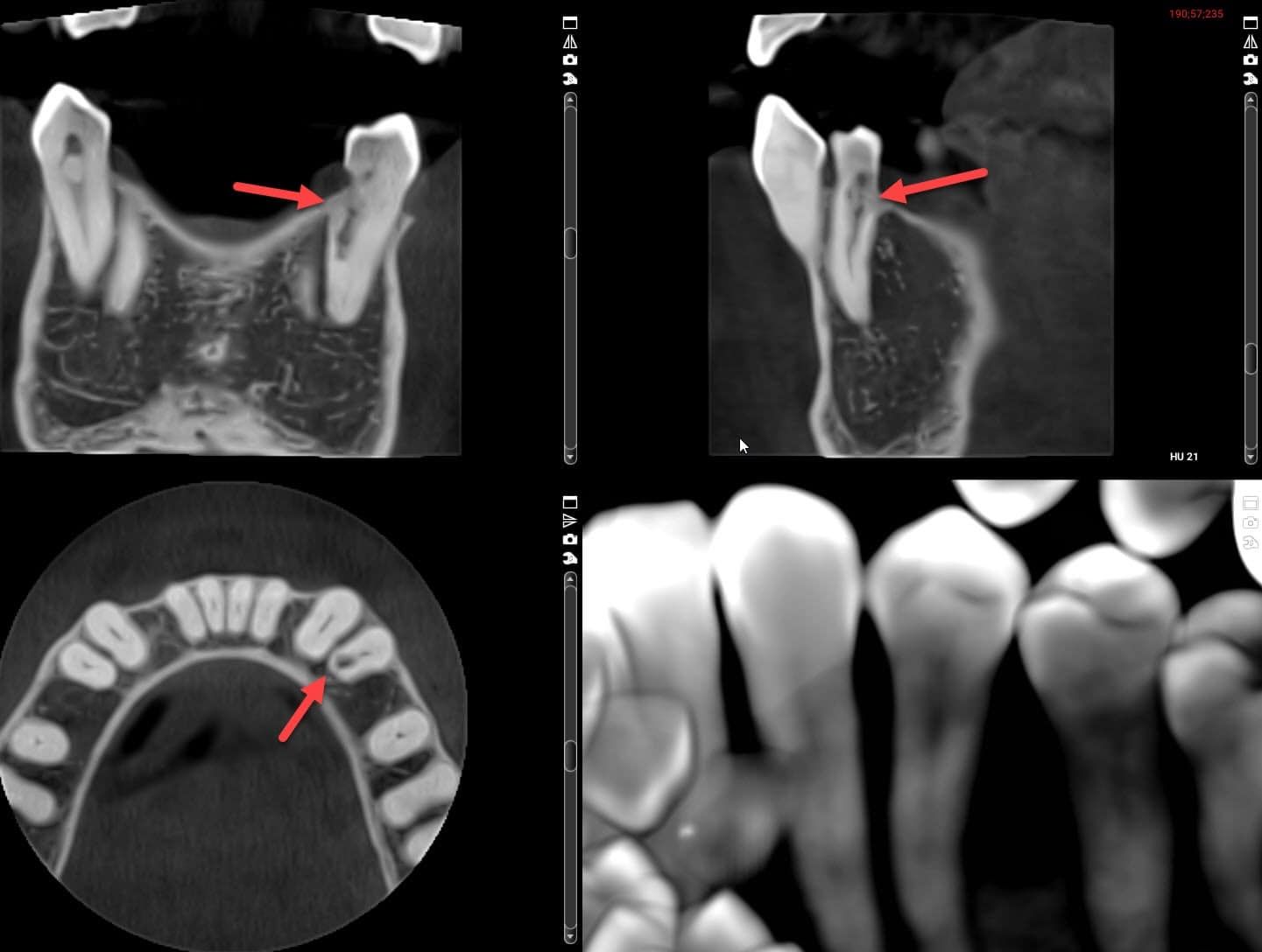 Dental CT scan showing several views of teeth, highlighted by red arrows, indicating a possible dental issue.