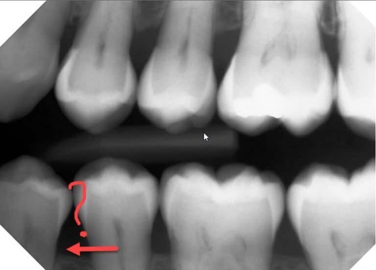 Dental X-ray showing teeth with a red arrow pointing to a possible cavity.