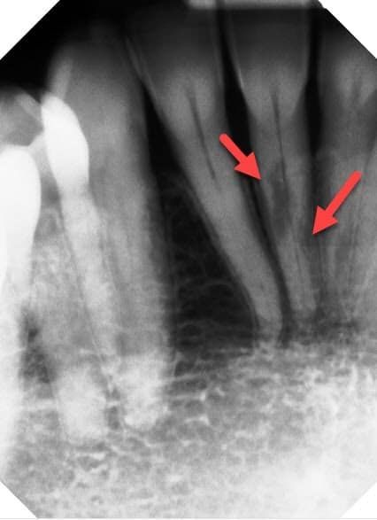 Dental X-ray showing root canals, highlighted by red arrows, revealing possible decay in teeth.