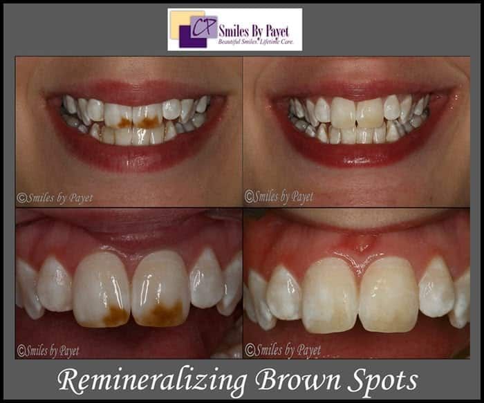 Before and after photos of teeth, showing the removal of brown spots.