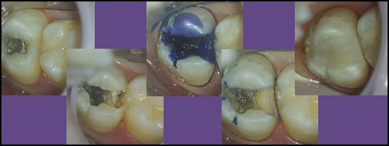 Dental images: teeth with fillings, a tooth with blue dye, and a completed filling.