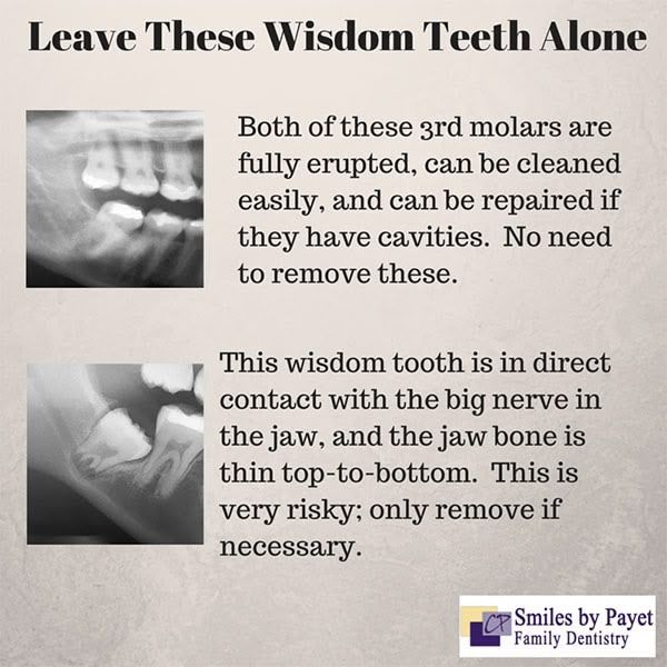 Two dental X-rays: one shows healthy wisdom teeth, the other risky, near a nerve. Text advises caution.
