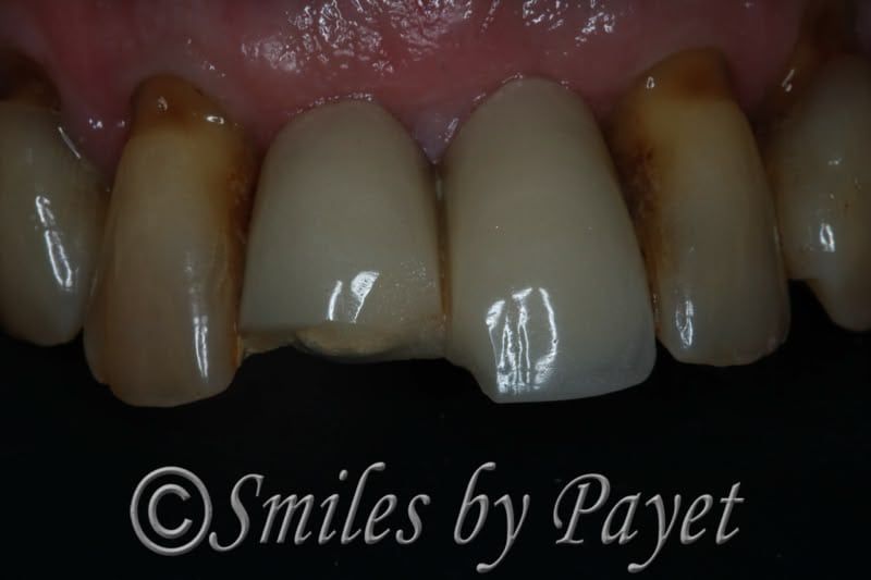 Close-up of teeth; chipped front tooth with discoloration and gum inflammation.