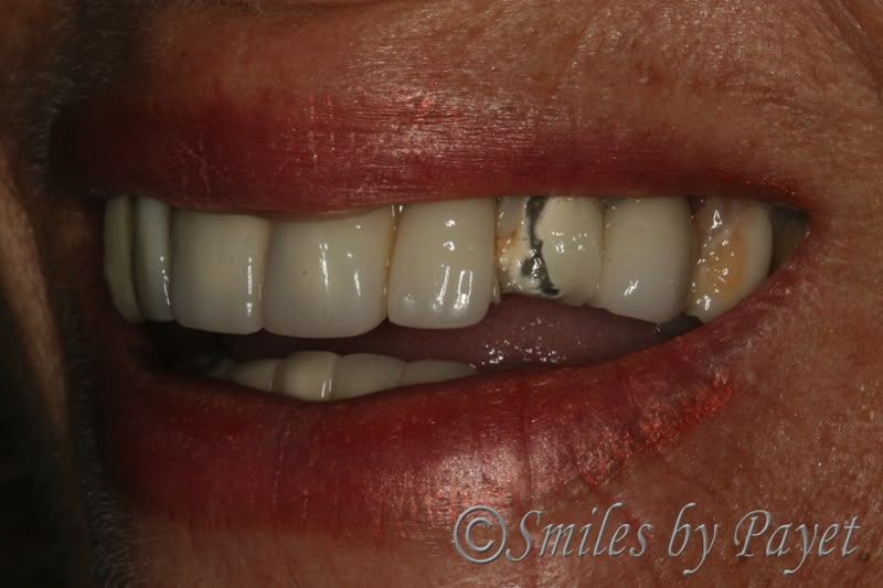 Close-up of a person's mouth. Damaged teeth are visible next to newer dental work. Red lipstick.