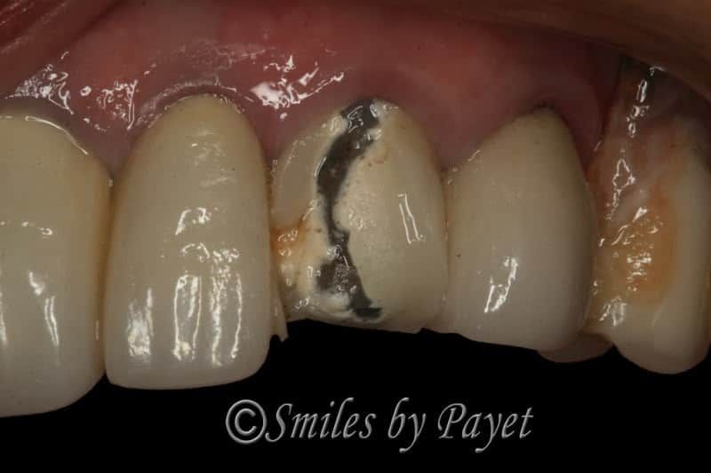 Close-up of teeth. Damaged central incisor with dark filling and surrounding teeth with bright, opaque surfaces.