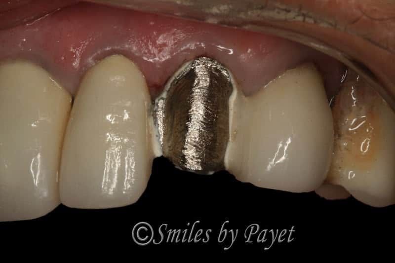 Dental bridge with porcelain crowns and a metallic middle section.