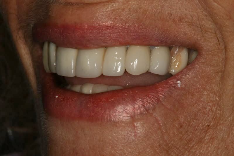 Person smiles, revealing a set of white dental implants, some with a yellowing natural tooth. Red lips.