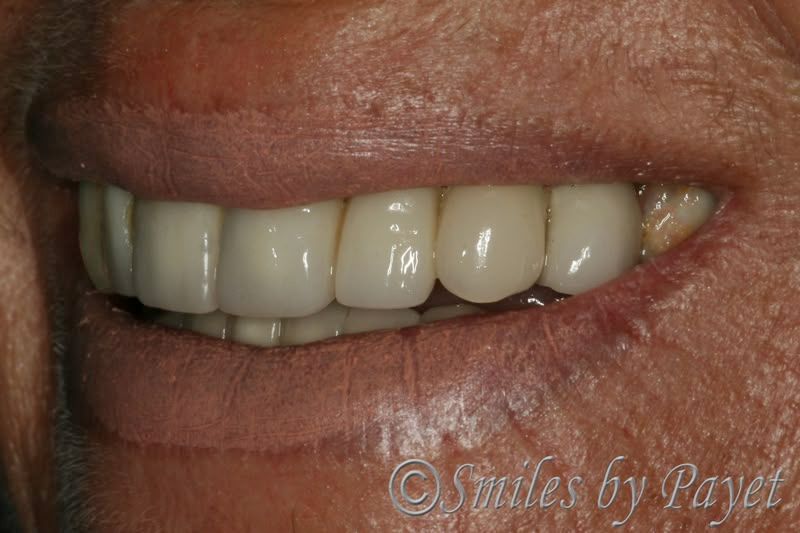Close-up of a person's smiling mouth showing a set of bright white dental implants.