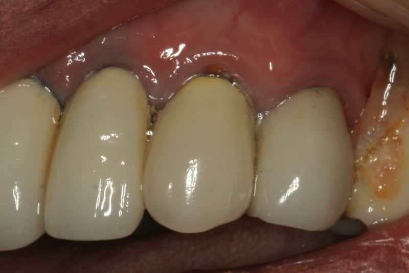 Close-up view of three dental crowns in the mouth, surrounded by gum tissue.