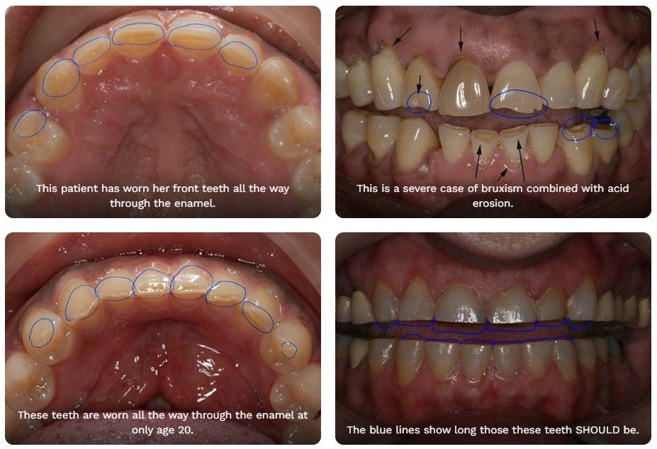 Four dental photos: teeth with enamel erosion, a mouth guard, and outlined teeth.