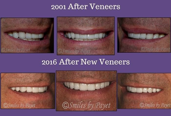 Comparison of teeth before and after veneer procedures in 2001 and 2016.