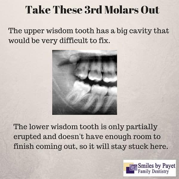 X-ray of teeth, with text advising removal of wisdom teeth due to a cavity and impaction.