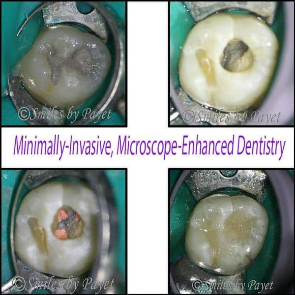 Four close-up dental views of a tooth with the stages of treatment. Each view shows a different step.