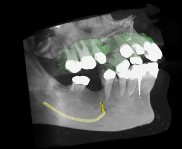 Dental x-ray scan of teeth, with some highlighted in green, and a yellow, tube-like structure in the jaw.