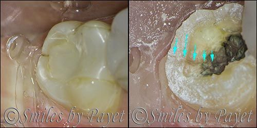 Dental images showing a healthy tooth and a tooth with decay. The decayed tooth has a large cavity.