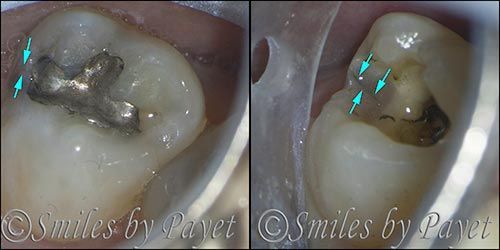 Two dental images: tooth with silver filling and a tooth with a dark area, both marked with arrows.