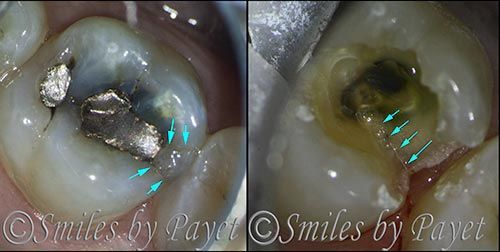 Two dental photos: tooth with old silver filling and decay; second photo shows cavity after removal.